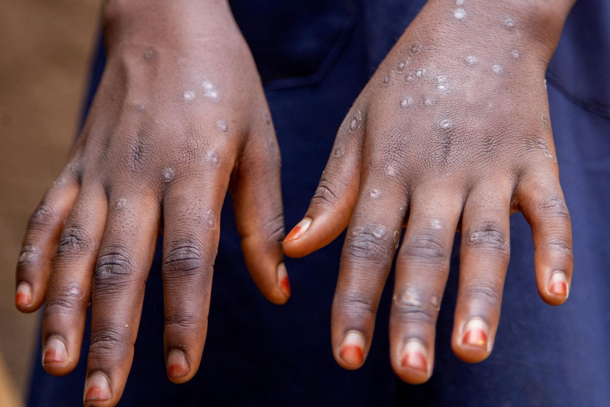 Government Trains More Than 2000 Teachers To Fight Mpox